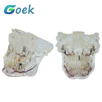 Zubné Jasné, Patologické Model S Nervovými C13 Učebné Zdroje Zubár Príslušenstvo Nástroje Model Zubov Stomatológia